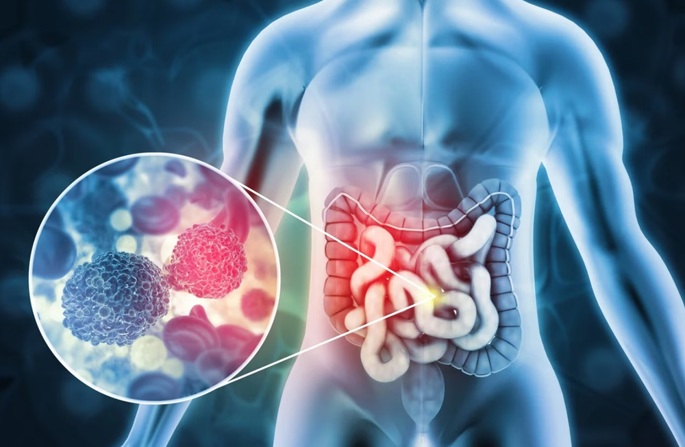 Bác sĩ Bạch Mai cảnh báo 1 loại ung thư gây tử vong thứ 3 thế giới đang ‘tăng tốc’, là hệ quả của ăn uống thiếu lành mạnh, ít vận động - ảnh 1