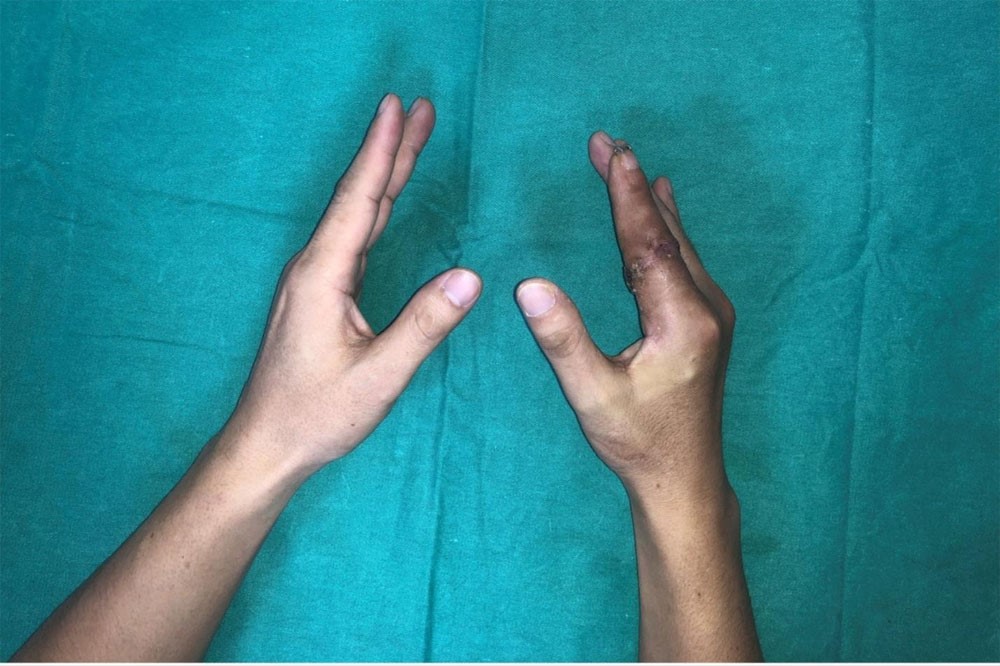 Kỳ tích y khoa lần đầu ghi nhận tại Việt Nam: Ngón tay đứt rời được cứu sống ngoạn mục sau 25 giờ - ảnh 2