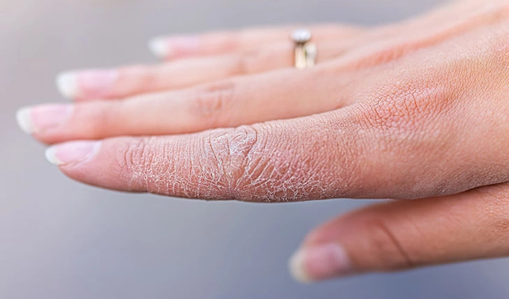 Gia tăng các bệnh da liễu trong mùa lạnh, hanh khô: Bác sĩ Bệnh viện 108 mách '3 không, 2 đủ' để bảo vệ làn da - ảnh 1