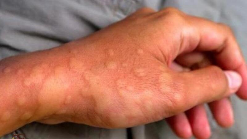 Gia tăng các bệnh da liễu trong mùa lạnh, hanh khô: Bác sĩ Bệnh viện 108 mách '3 không, 2 đủ' để bảo vệ làn da - ảnh 3