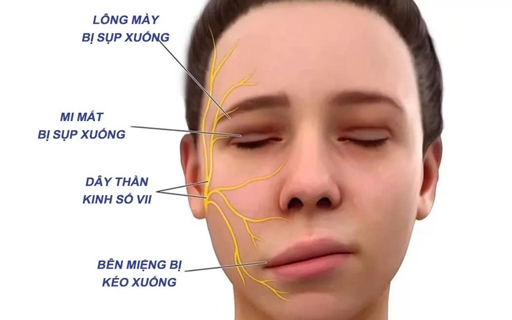 Ngủ dậy bỗng méo miệng, lệch mặt, không nhắm kín mắt: Bác sĩ cảnh báo bệnh dễ gặp khi trời rét - ảnh 2