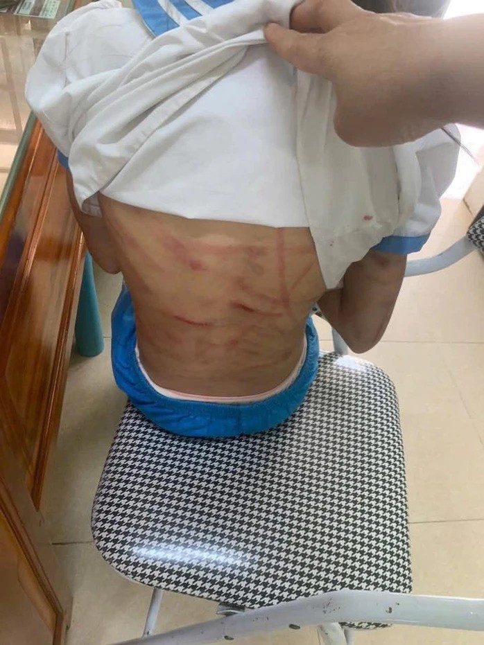 Bé gái lớp 5 nghi bị cha dượng bạo hành: Vùng đầu chảy máu, chân khó cử động - ảnh 1