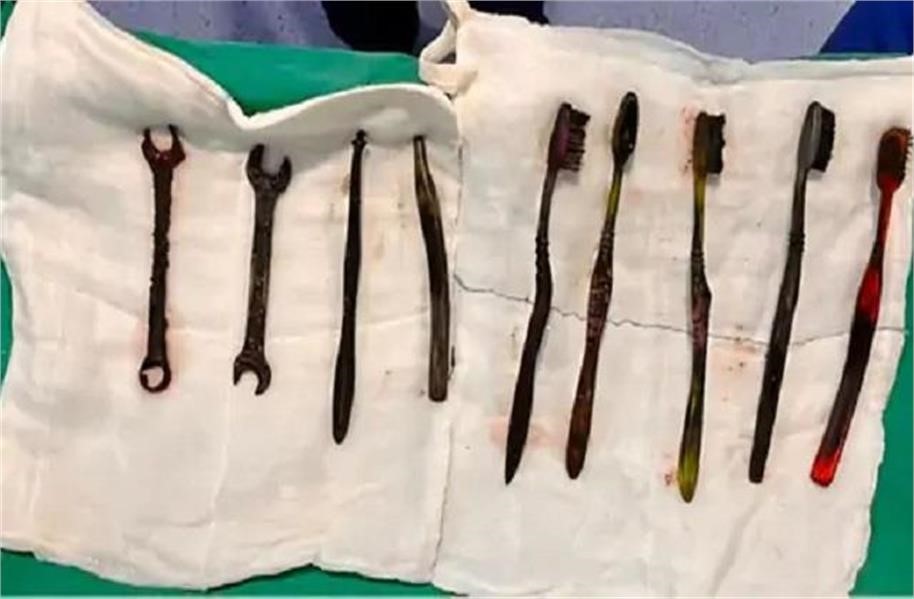 Mổ khẩn cấp, lấy 7 bàn chải đánh răng, 2 chiếc cờ lê trong bụng một người đàn ông 26 tuổi - ảnh 1