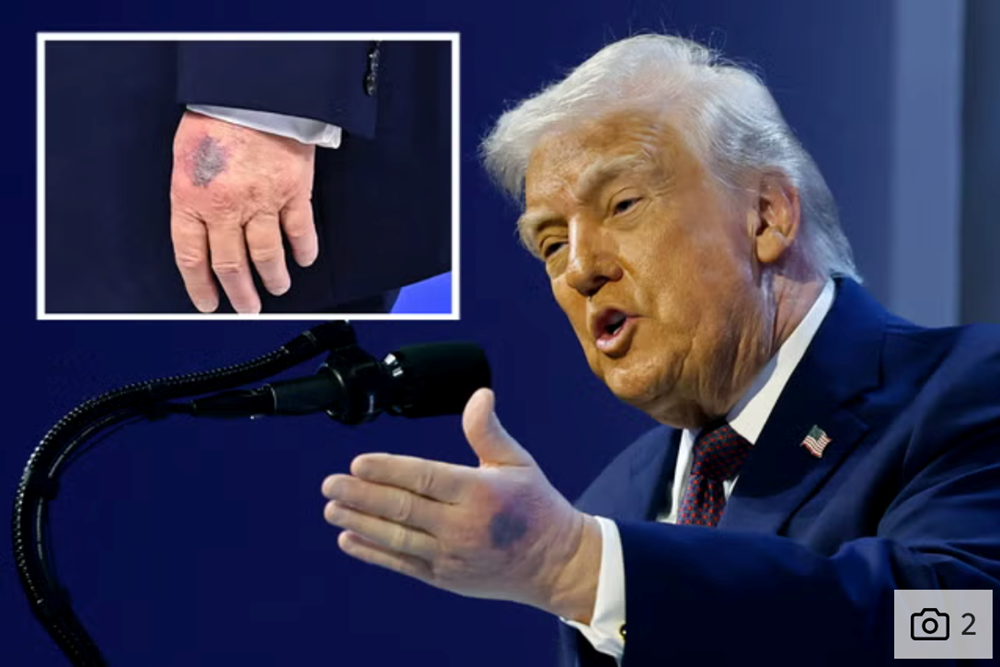 Lộ ảnh một bên tay bị bầm tím gây sốt cộng đồng mạng, ông Trump nói gì? - ảnh 1