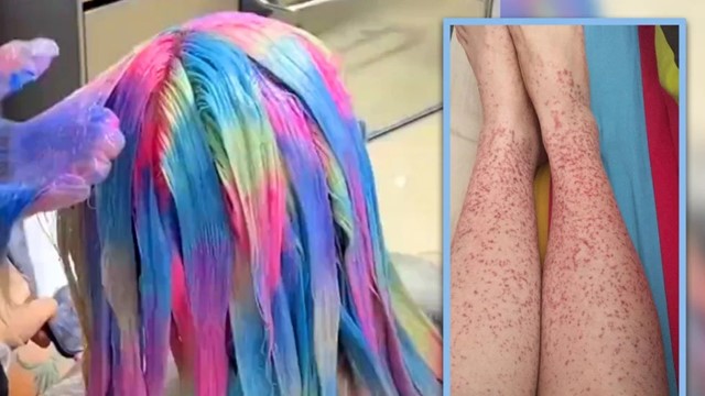 Tháng nào cũng nhuộm tóc, cô gái Trung Quốc phát hiện mắc bệnh thận