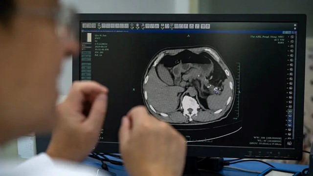 AI Trung Quốc giúp phát hiện sớm loại ung thư có tiên lượng xấu nhất hiện nay