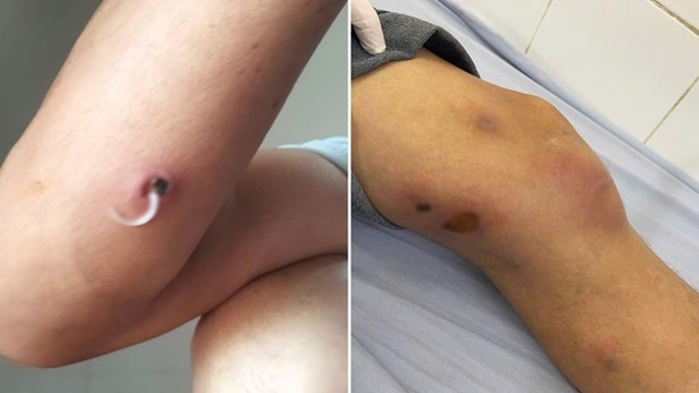 Phát hiện căn bệnh hiếm, chưa có vaccine phòng ngừa tại Việt Nam 