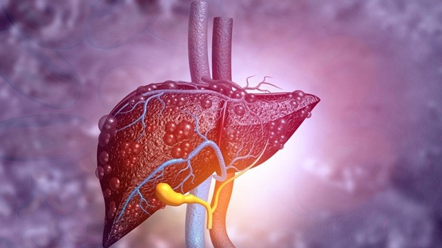 Vì sao người gầy vẫn có thể bị gan nhiễm mỡ?