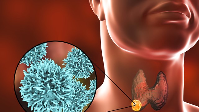 Loại ung thư nguy hiểm đang tăng rất nhanh, Việt Nam ghi nhận hơn 6.000 ca mắc mới mỗi năm