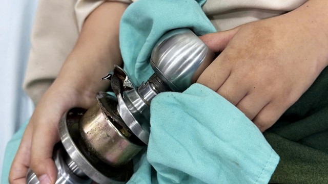 Bé trai 5 tuổi nhập viện cấp cứu vì kẹt ngón tay vào ổ khóa cửa