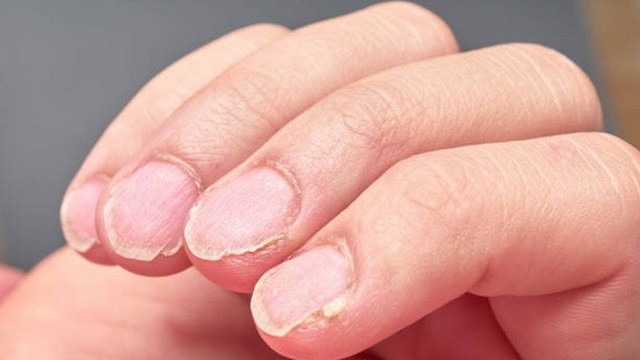 5 dấu hiệu cảnh báo cơ thể thiếu sắt, cần bổ sung ngay