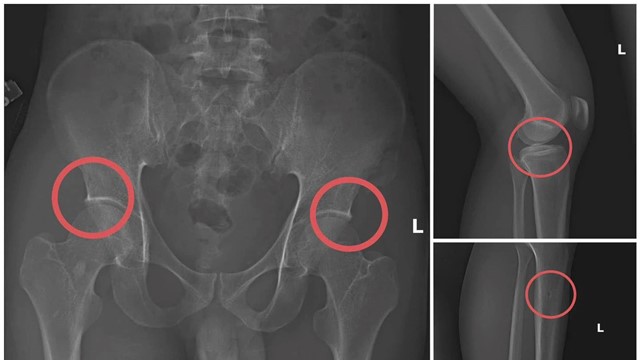 Vạch trần đường dây trục lợi bảo hiểm: Tiêm thuốc mê, dùng búa đập xương để lấy tiền bồi thường