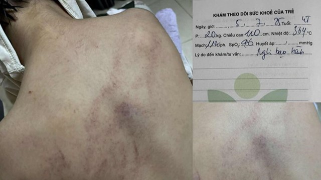 Tạm đình chỉ cô giáo mầm non đánh đập, kéo lê, ném bé gái 4 tuổi vào tường