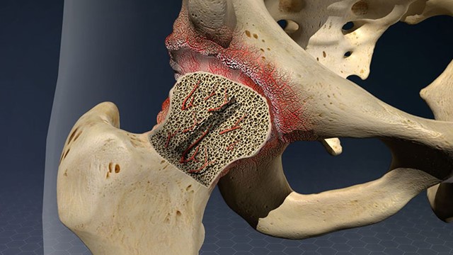 Người từng mắc Covid-19 có nguy cơ bị hoại tử xương