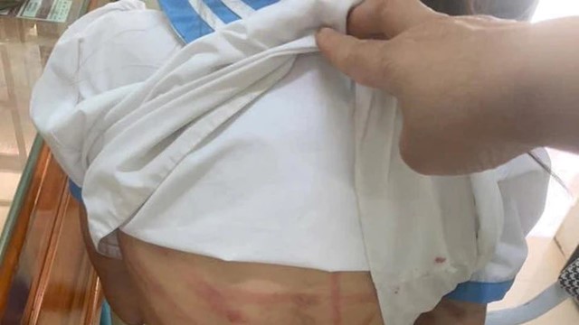 Bé gái lớp 5 nghi bị cha dượng bạo hành: Vùng đầu chảy máu, chân khó cử động