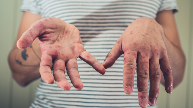 Loại virus đang bùng phát mạnh ‘vượt ngoài tầm kiểm soát’, tiếp tục gây nguy hiểm trong 25 năm tới