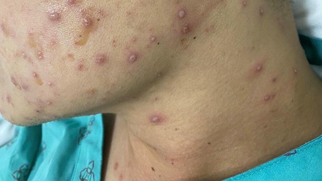 Căn bệnh lây nhanh đang bùng phát khi trời lạnh, hiện chưa có thuốc đặc trị