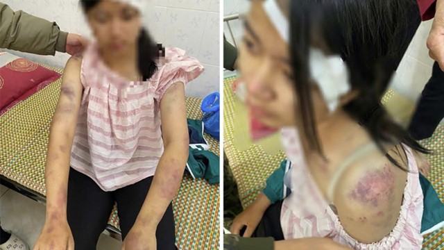 Công an khẩn trương xác minh vụ bé gái 13 tuổi bị ông bà nội tra tấn dã man, phải nhập viện
