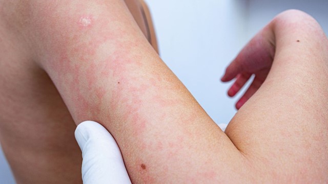 Virus gây bệnh truyền nhiễm quay trở lại, một thành phố ghi nhận hơn 32.600 ca mắc