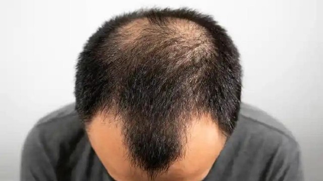 Đàn ông có thể sống thọ bao lâu chỉ cần nhìn mái tóc là biết? Cảnh báo nếu xuất hiện 3 dấu hiệu này, cần đặc biệt chú ý!