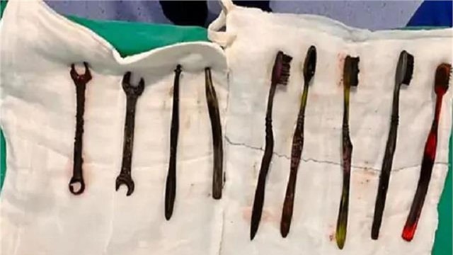 Mổ khẩn cấp, lấy 7 bàn chải đánh răng, 2 chiếc cờ lê trong bụng một người đàn ông 26 tuổi